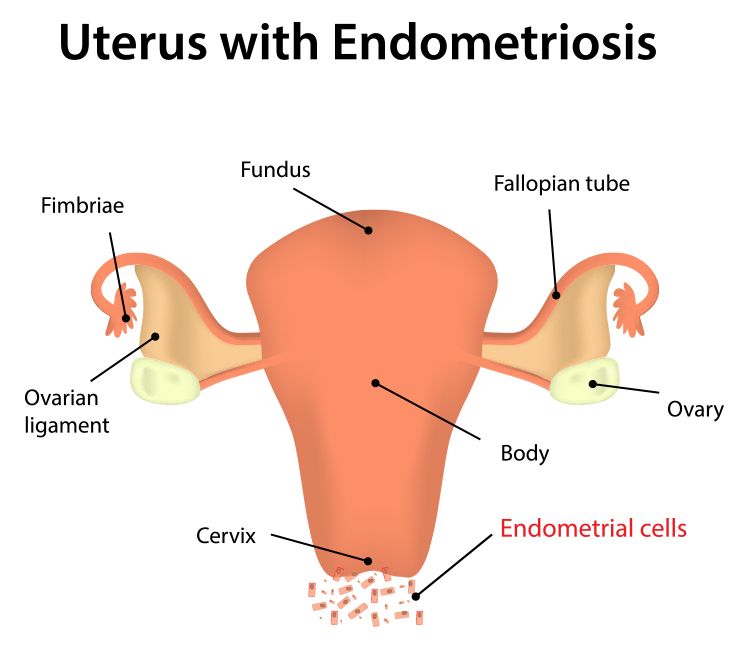 Uterus with Endometriosis