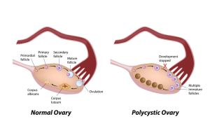 Intrauterine Insemination to Address PCOS