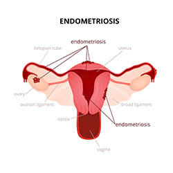 IVF with Endometriosis